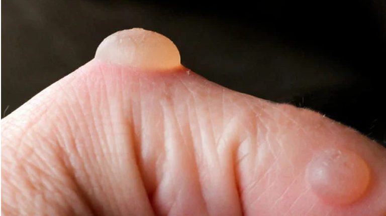 What is Blisterata? Understanding Symptoms, Causes, Treatment, and Prevention